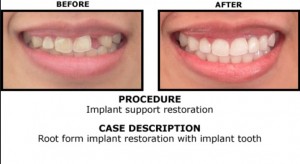 single-tooth-implant-dentist-parramatta