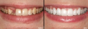 single tooth implant