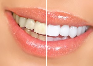 teeth-whitening-parramatta