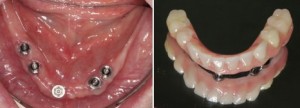 the 4 implant process 1