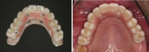 the 4 implant process