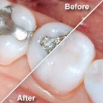 Ceramic Dental Fillings