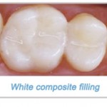 Composite Resin Dental Fillings