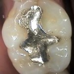 silver amalgam dental fillings
