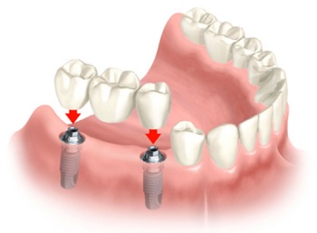 dental-implants