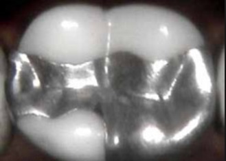 silver-fillings-example