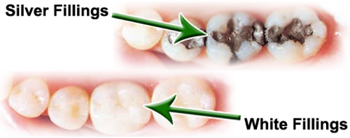 silver-fillings