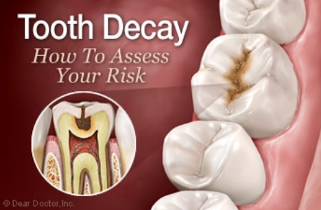 tooth decay