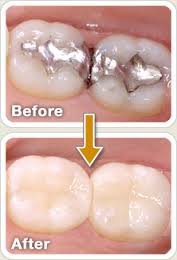 Parramatta dental filling treatment