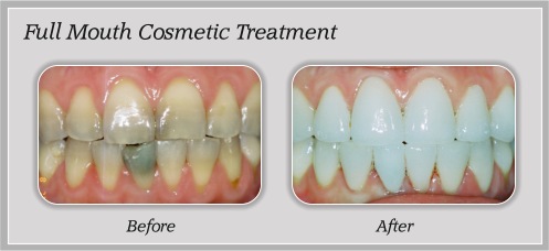 dental fillings in Parramatta