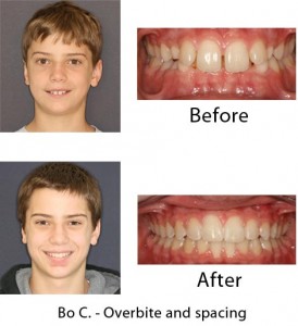 dental invisalign before and after