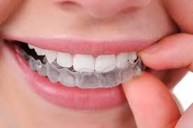 dental invisalign in parramatta