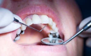 patient having a dental chech up, close up with narrow depth of fiels focus on probe