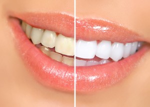 effective teeth whitening in parramatta