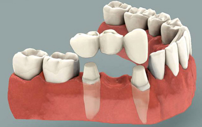 parramatta dental crown and bridges