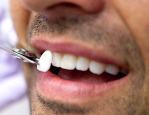 parramatta dental veneers