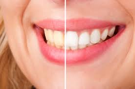 teeth whitening in parramatta affordable
