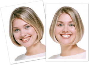 benefits of teeth whitening